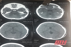 Bệnh viện Nhi Thanh Hóa điều trị thành công bệnh nhân bị vết thương sọ não hở do chó cắn