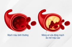 Kiểm soát mỡ máu tăng cao - Phòng ngừa biến chứng nguy hiểm