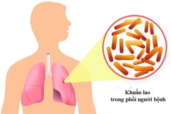 Thủ tướng Chính phủ chỉ đạo tăng cường công tác phòng, chống bệnh Lao