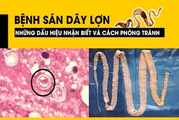 [Infographics] Bệnh sán dây lợn - Những dấu hiệu nhận biết và cách phòng tránh