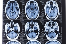 Nghiên cứu: COVID-19 có thể để lại di chứng ở não người bệnh
