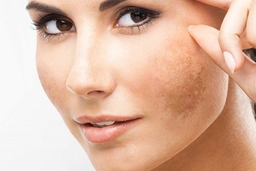 Bệnh nám da là gì? Có thể điều trị được hay không?