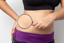 Sản phẩm  điều trị  rạn da loại nào hiệu quả nhất trên thị trường hiện nay?