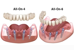 Trồng răng All-on-4, All-on-6: Giải pháp tối ưu cho người mất răng toàn hàm