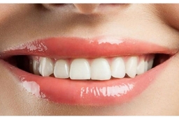 Bọc răng sứ răng cửa khi nào? Chi phí thực hiện hết bao nhiêu?