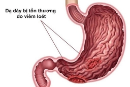 Cẩn thận với các triệu chứng viêm loét dạ dày gây ung thư sớm