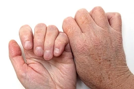 Bệnh da thường gặp khi chuyển mùa Hè sang Thu và cách phòng tránh