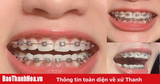 Bác sĩ sử dụng phương pháp nào để dàn đều răng trong giai đoạn này?

